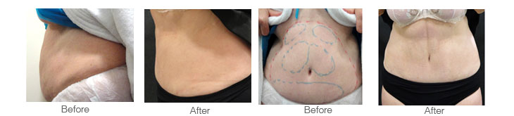 before and after photographs of abdoman reshaping using laser surgery